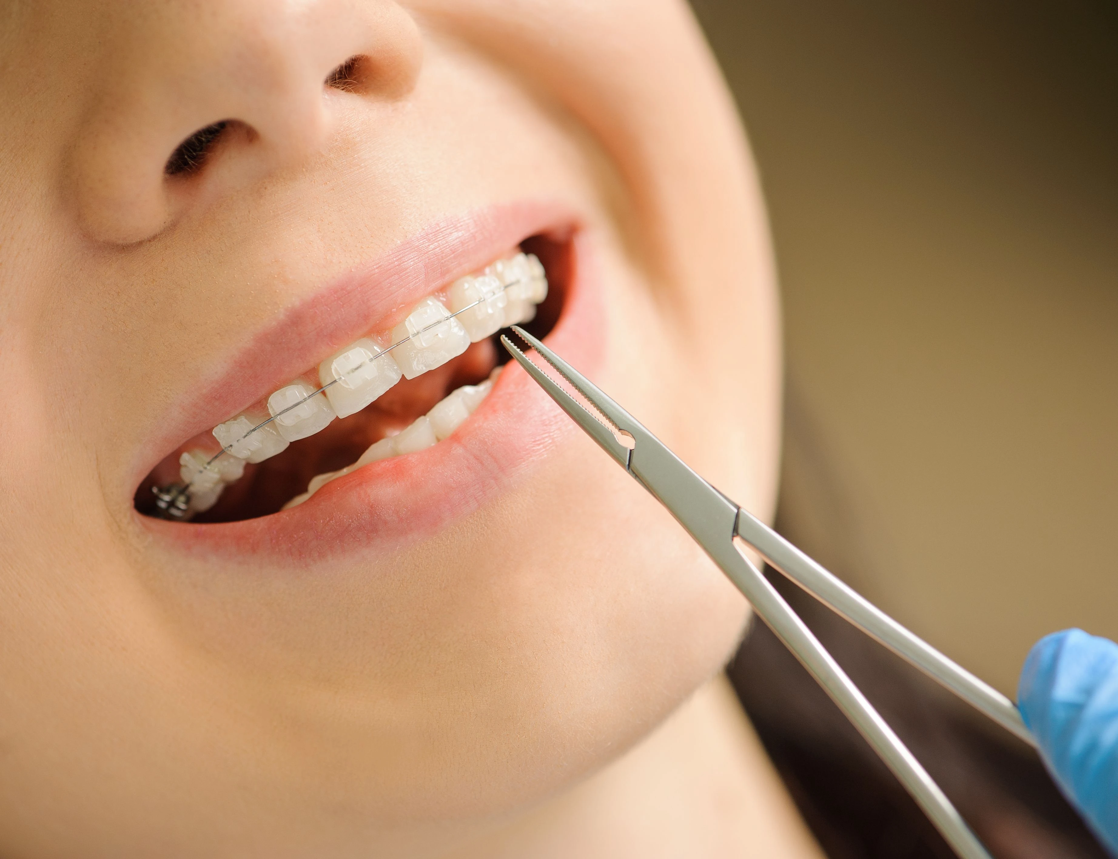 Close-up of ceramic braces on teeth