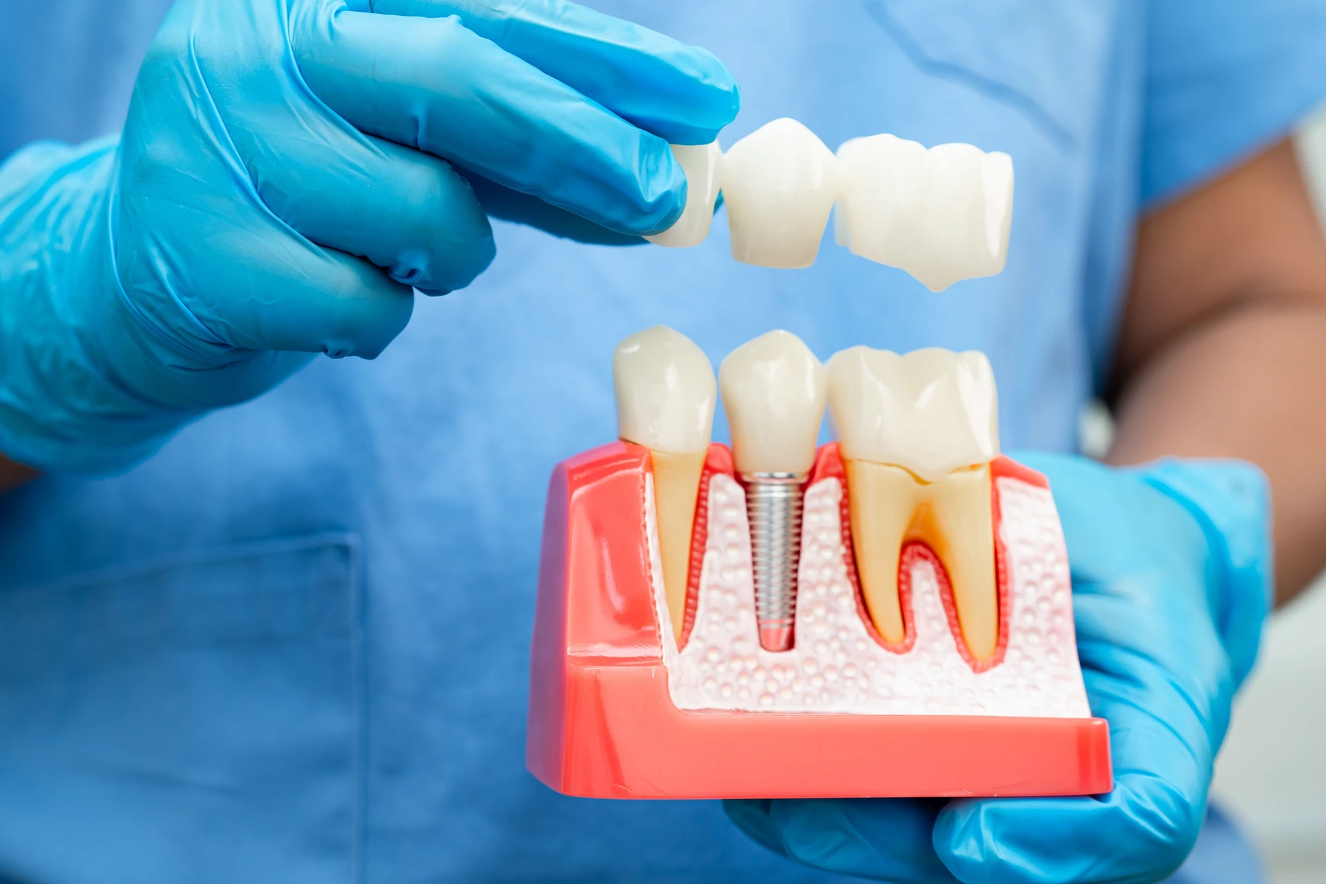 Implant dentistry treatment