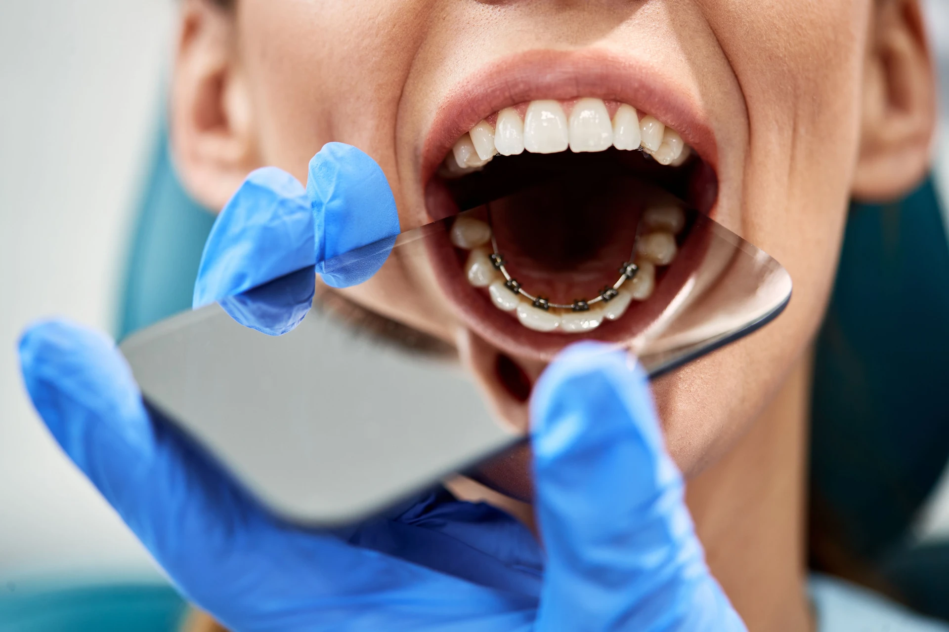Close-up of lingual braces on the back of teeth