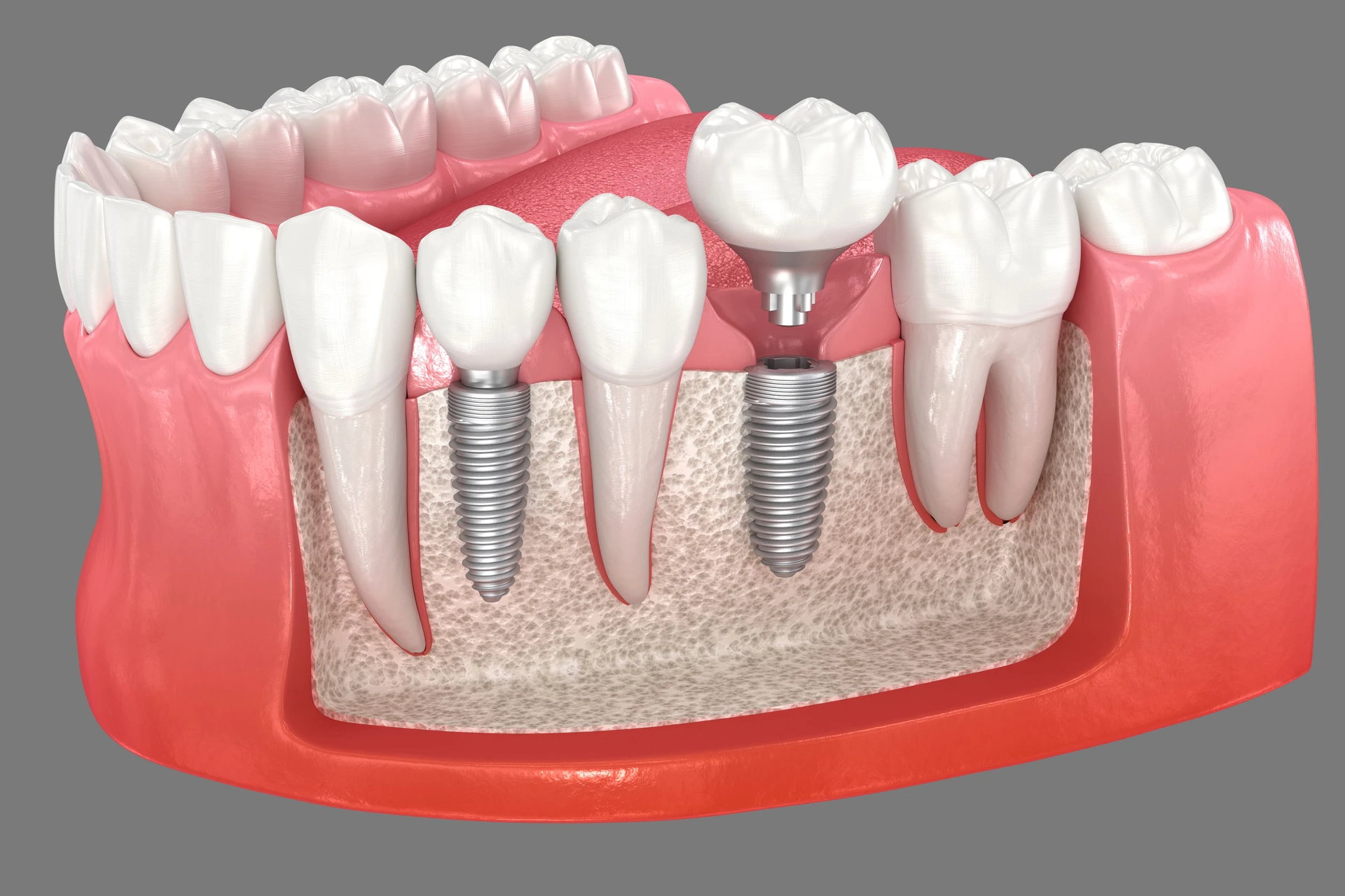 Restorative dental care